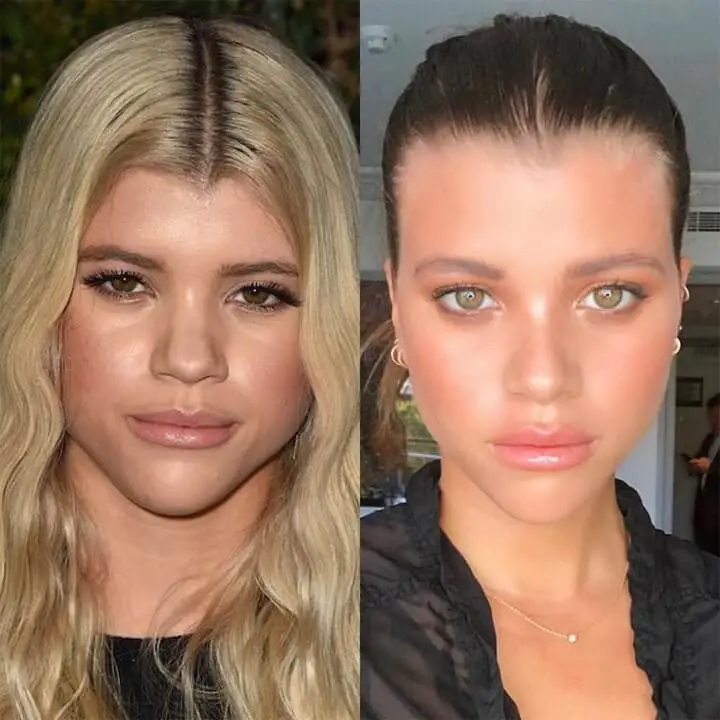 sofia richie nose job