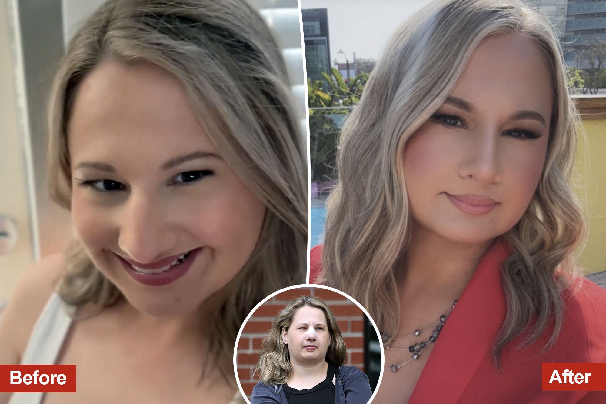 gypsy rose rhinoplasty