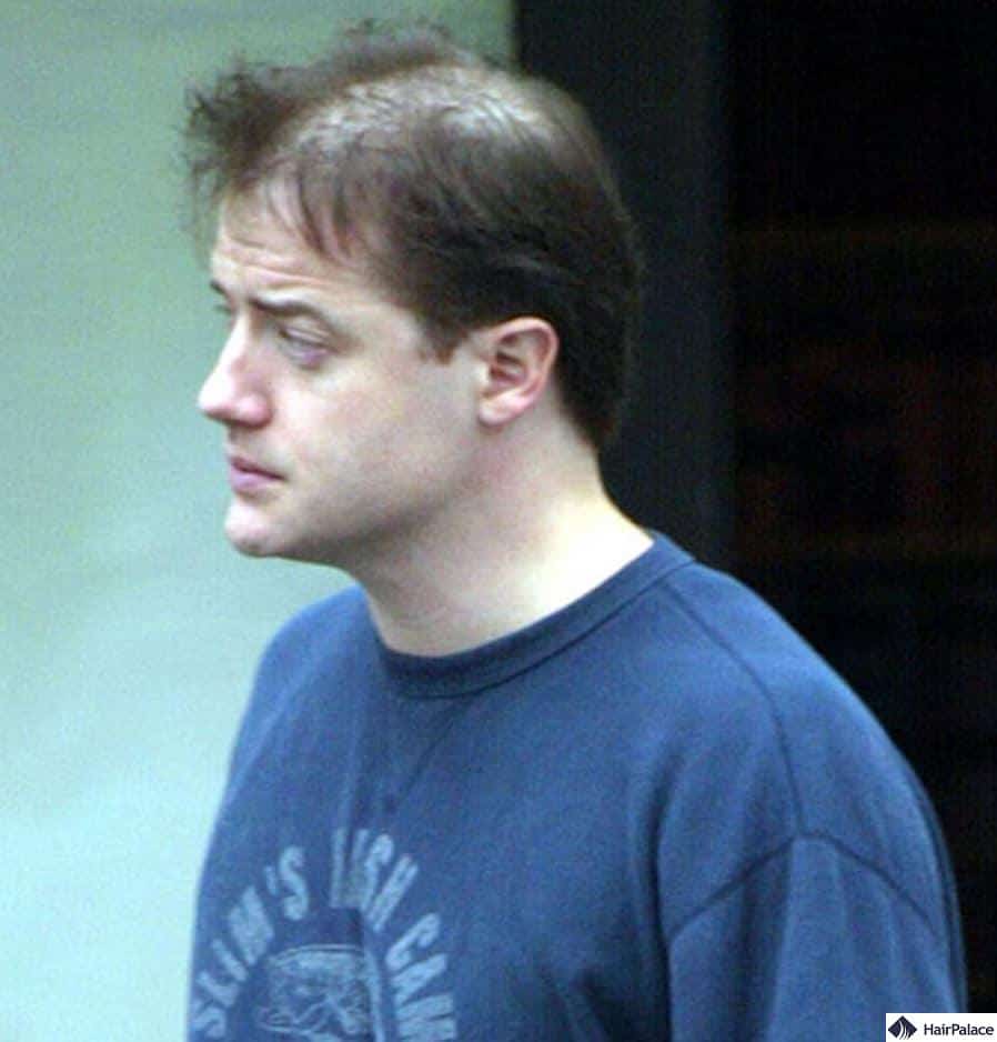 brendan fraser balding