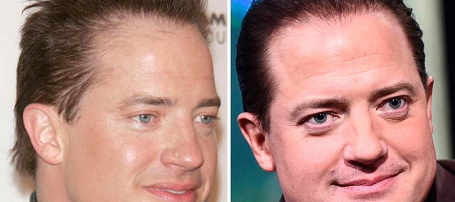 brendan fraser balding