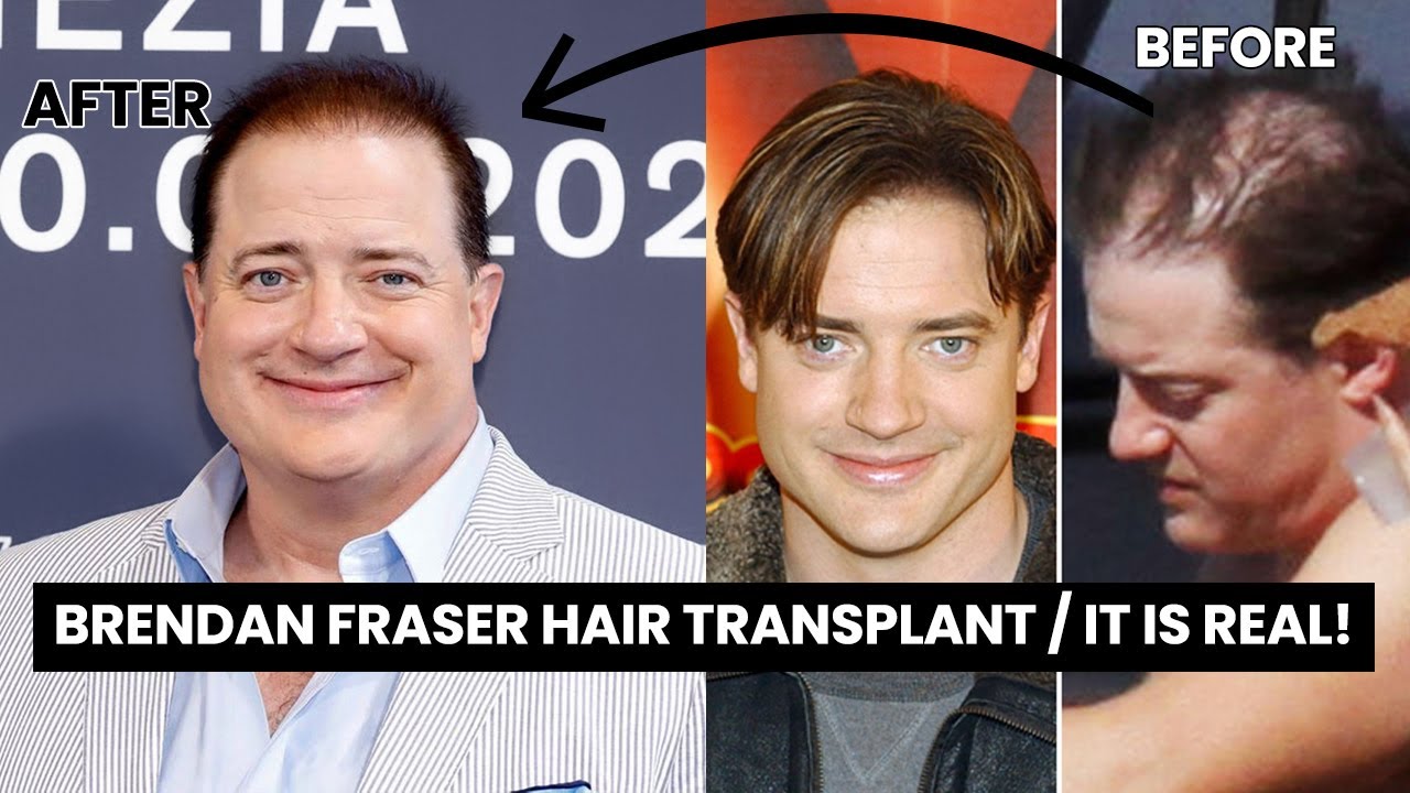 brendan fraser balding