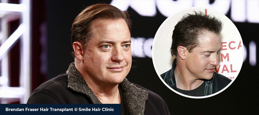 brendan fraser balding