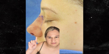 gypsy rose rhinoplasty