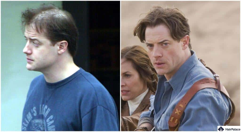 brendan fraser balding